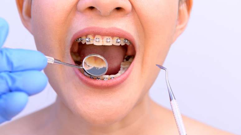 Segundo o cirurgião-dentista existem diversos tipos de aparelhos ortodônticos