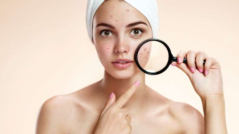 Saiba como amenizar os efeitos da acne!