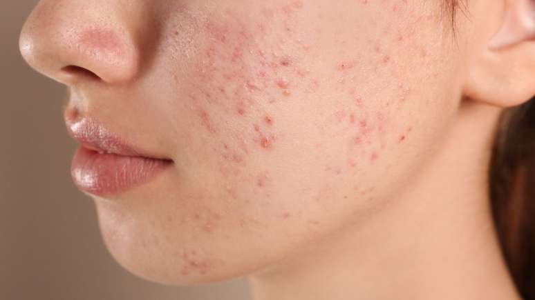 Tudo o que você precisa saber sobre as cicatrizes de acne!