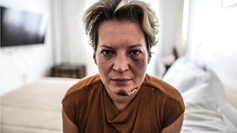 Joice Hasselmann é fotografada com hematomas no rosto em seu apartamento funcional em Brasília