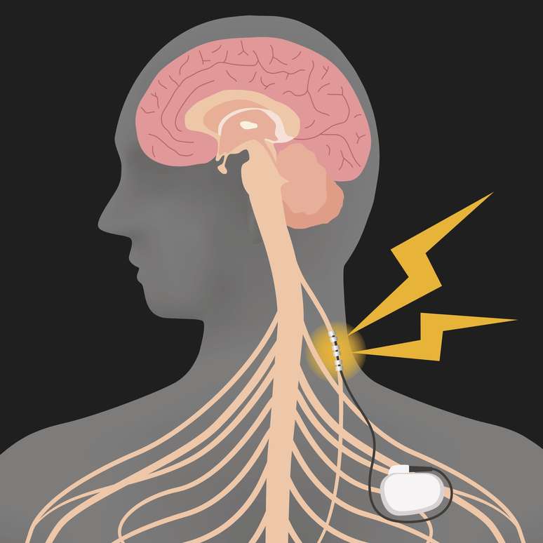 A instalação de marca-passos no nervo vago pode estimular a produção de neurotransmissores no cérebro capazes de regular as emoções