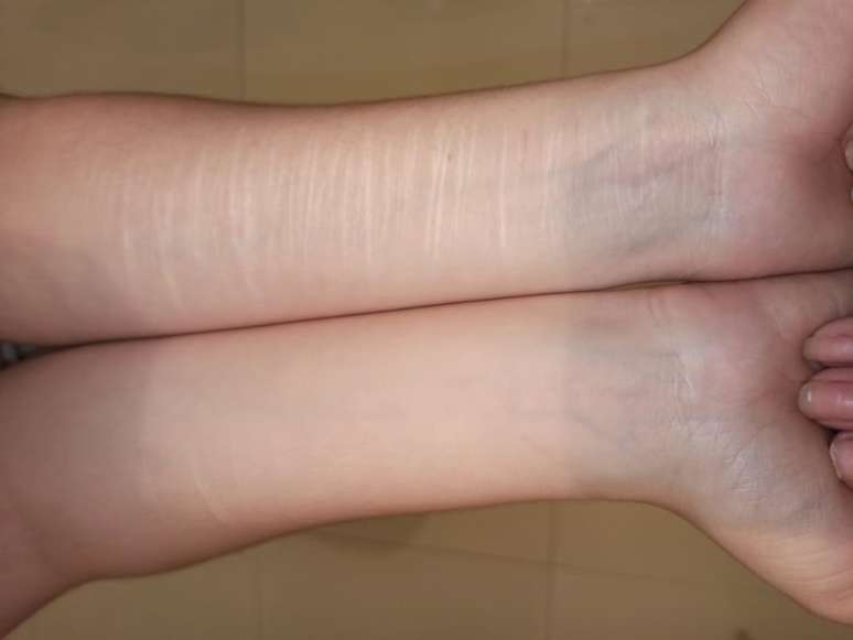 Lara mostra les&otilde;es que fez em si. Ela afirma que foi uma forma de aliviar a dor que sentiu ap&oacute;s v&iacute;deo viralizar