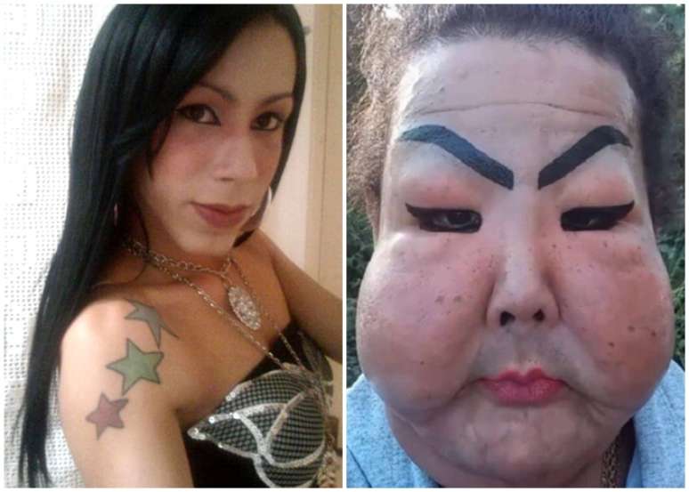A transexual Juju Oliveira antes e depois da aplicação com finalidade estética que deformou seu rosto