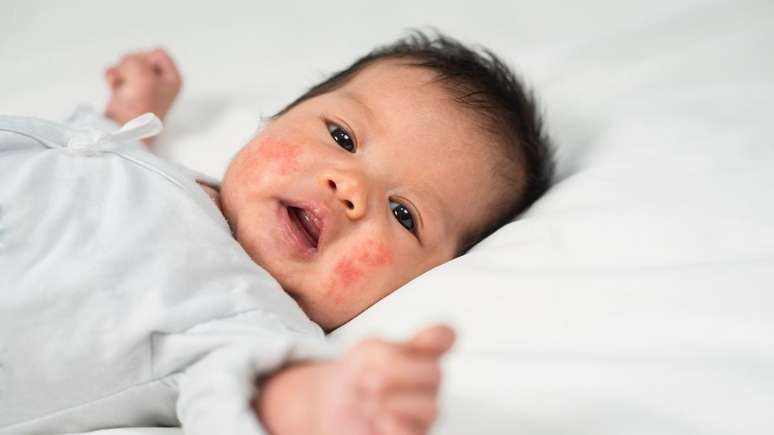 Alergia em bebês: saiba como combater