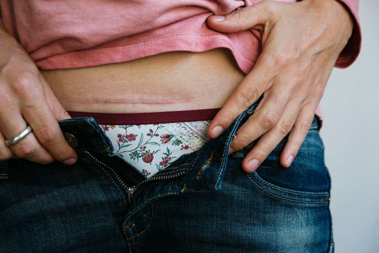 Cicatriz de cesárea: como cuidar e evitar estes 3 problemas - Minha Vida