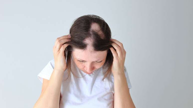 A doença provoca falhas no couro cabeludo