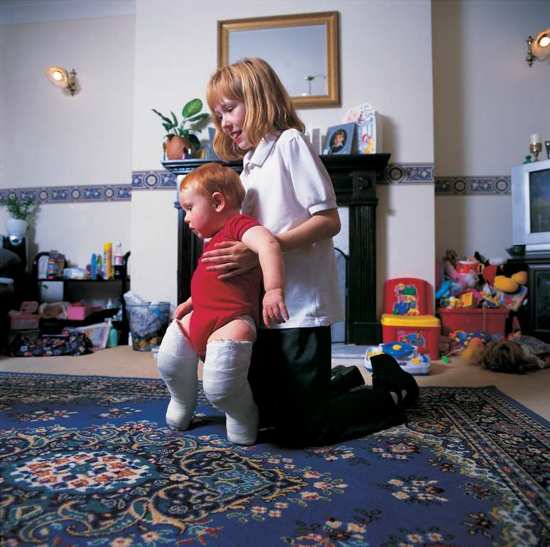 Criança usando gesso, parte do tratamento de pé torto congênito