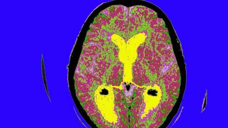 Ainda há muito a ser descoberto sobre o que se passa no cérebro de uma vítima do mal de Alzheimer
