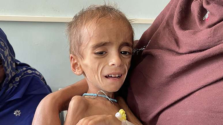 Criança desnutrida em hospital de Kandahar, fotografada em outubro