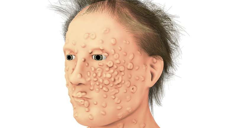 Muitos dos pacientes de varíola ficavam com cicatrizes terríveis no rosto e no corpo