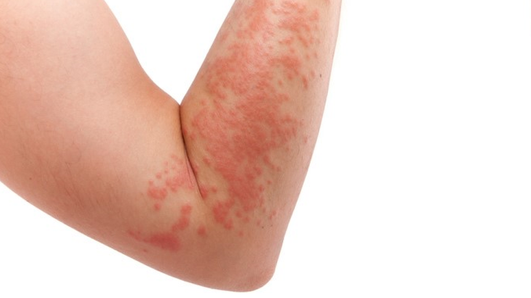 A dermatite é um tipo de inflamação que atinge a pele