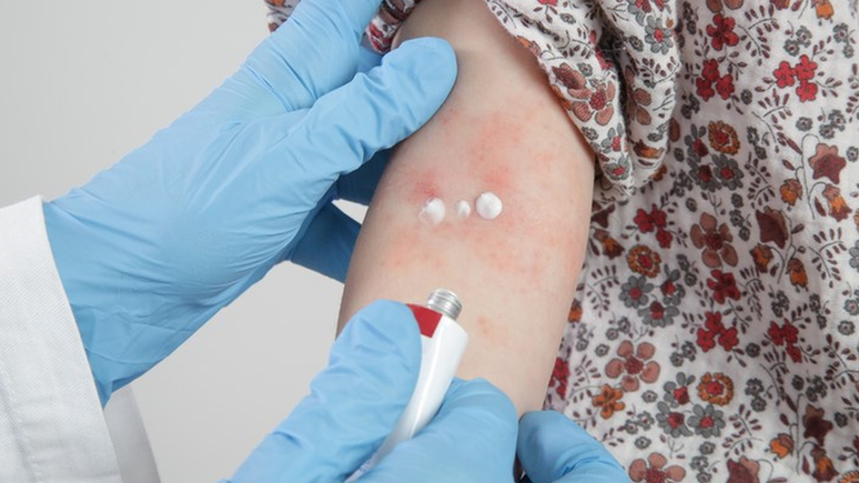 Geralmente, tratamentos com pomadas anti-inflamatórias prescritas pelo médico ajudam a tratar quadros de dermatite