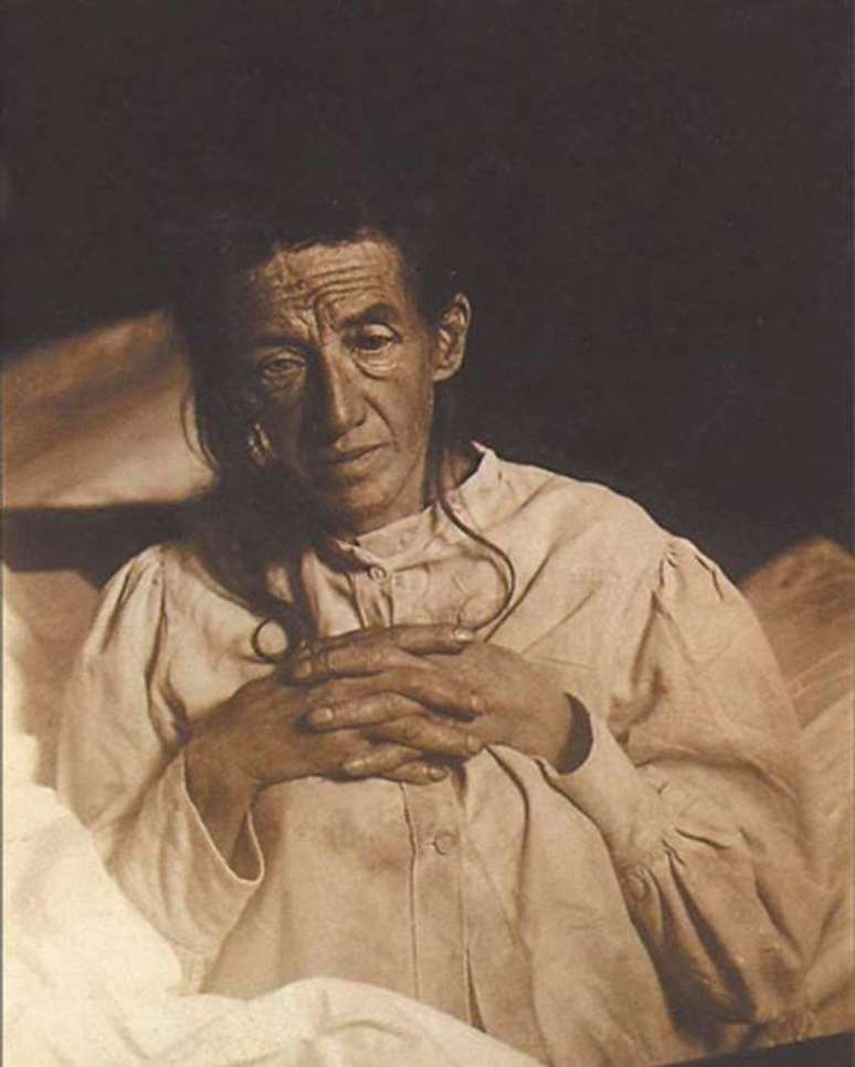 No início do século 20, Auguste Deter foi a primeira pessoa diagnosticada com mal de Alzheimer