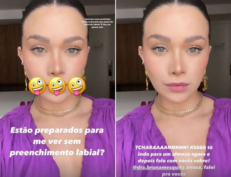 Flavia Pavanelli mostrou o resultado da remo&ccedil;&atilde;o do preenchimento labial nos stories do Instagram