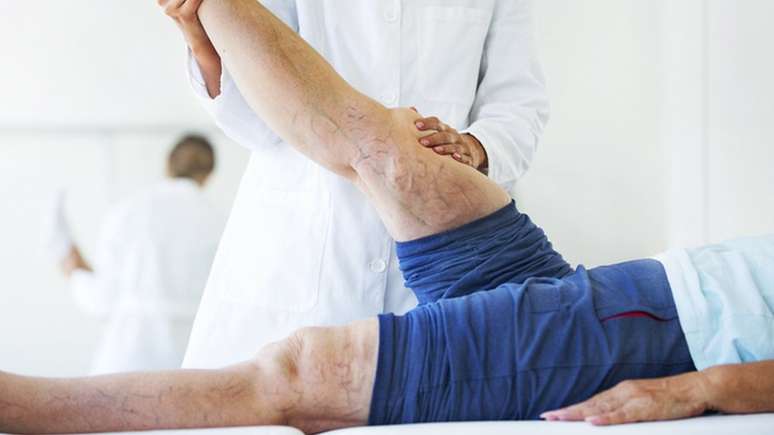 Quase 40% dos brasileiros têm varizes, quadro marcado pelo inchaço e pela deformação de veias superficiais que costuma surgir nas pernas
