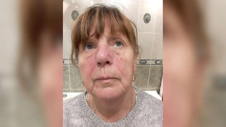 Janet Doyle disse que a ros&aacute;cea fez com que ela n&atilde;o quisesse sair de casa alguns dias