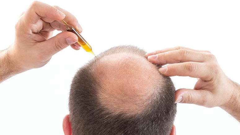 De acordo com a SBD, não há uma forma de prevenir a alopecia por se tratar de uma doença cujas causas são desconhecidas