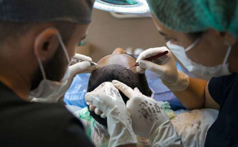 O transplante capilar &eacute; recomendado para pacientes acima dos 30 anos de idade&nbsp; 