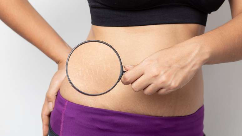 Com a tatuagem, as estrias se tornam imperceptíveis