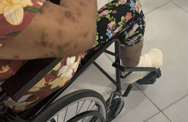 Mulher tem perna necrosada após demora em atendimento