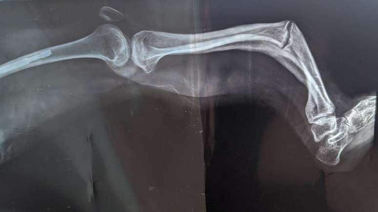 Beatriz sofreu diversas dores e fraturas ao longo da vida, certa vez, caiu sentada e quebrou a perna em forma de S