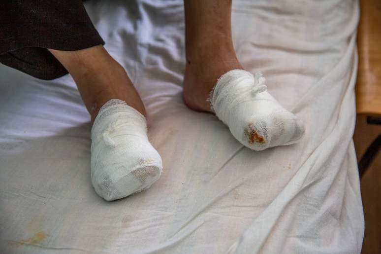 Nikita ter&aacute; que reaprender a andar depois que seus dedos foram amputados na R&uacute;ssia