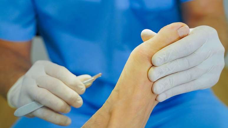 As cirurgias contra a fascite plantar s&oacute; est&aacute; indicada para a minoria de casos que n&atilde;o melhora com fisioterapia, exerc&iacute;cio e infiltra&ccedil;&otilde;es