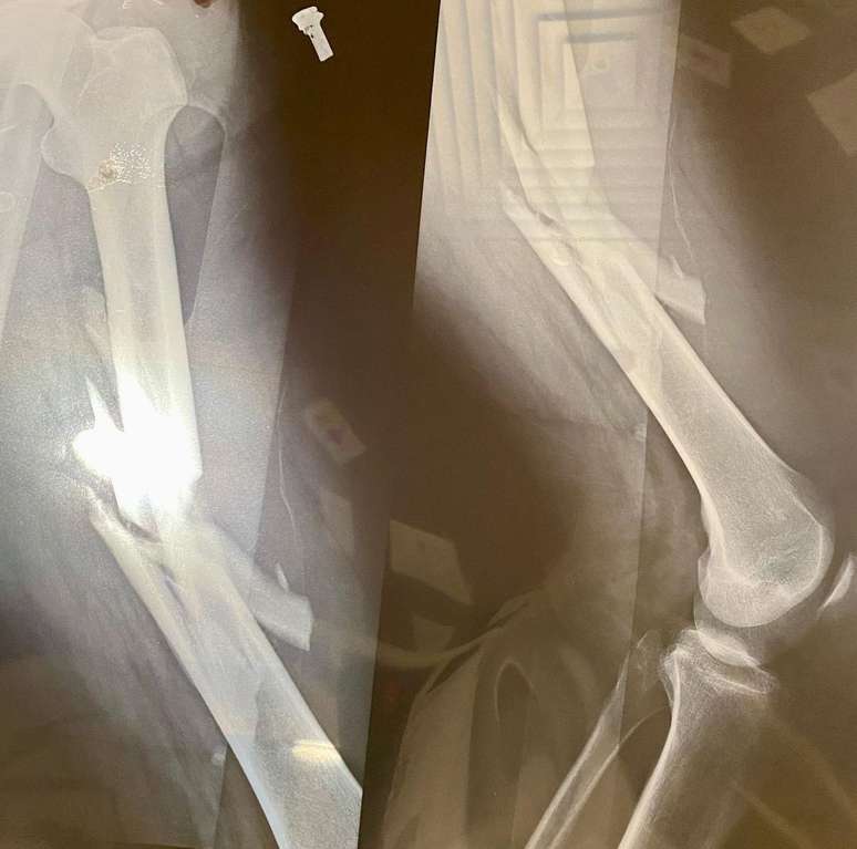 O ator também compartilhou fotos das radiografias