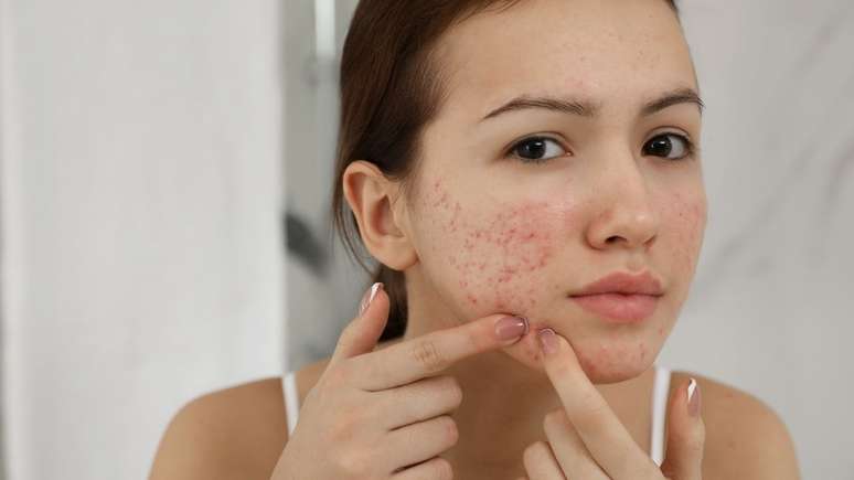 A acne ocorre a partir da obstrução dos folículos por óleo e células mortas