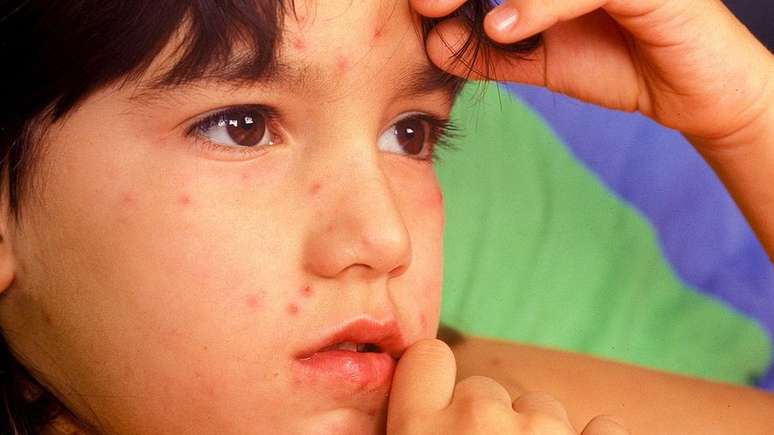 A varíola foi erradicada do mundo há 40 anos