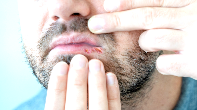 Herpes pode também causar feridas na boca