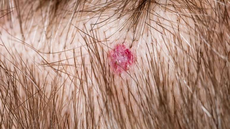 Manchas e pintas que aparecem no couro cabeludo podem ser indicativo de melanoma