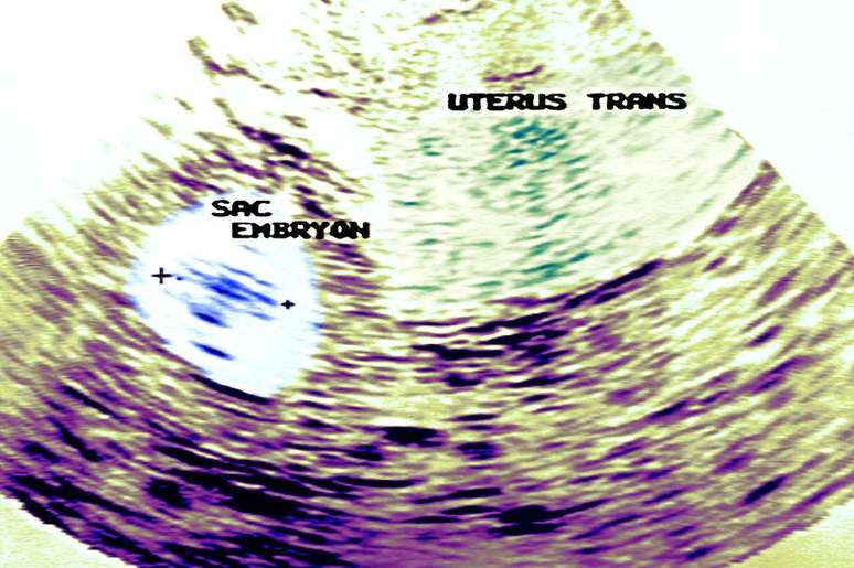 O ultrassom é um dos métodos para detectar gestações ectópicas