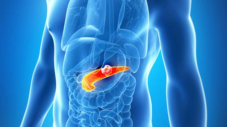 O câncer de pâncreas costuma ser agressivo e tem poucas opções de tratamento mais modernas
