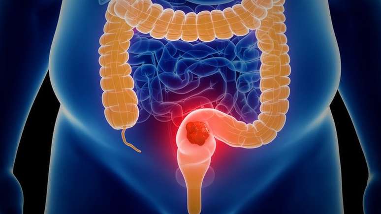 O câncer pode começar no cólon (intestino grosso) ou no reto (passagem posterior) e também é conhecido como câncer colorretal