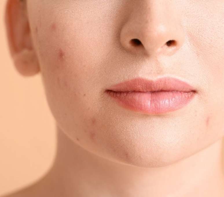 Se a acne surgir, o ideal &eacute; procurar o dermatologista 