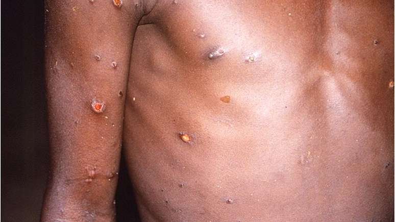 Varíola dos macacos provoca erupções na pele