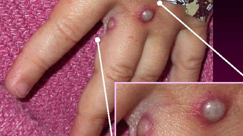 Essa é a mão de um dos 20 pacientes infectados com varíola dos macacos nos EUA em 2003, quando foram registrados os primeiros casos no continente americano