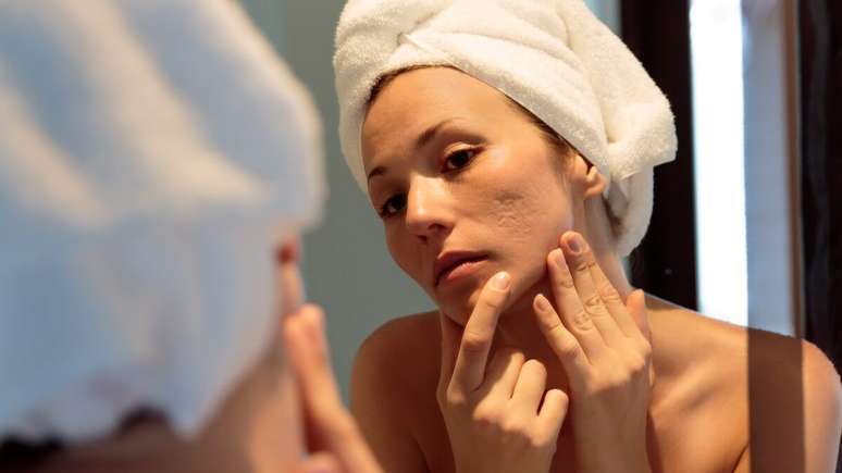 Conheça os segredos da acne