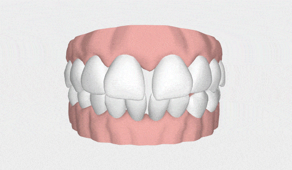 Ilustra&ccedil;&atilde;o de diastema
