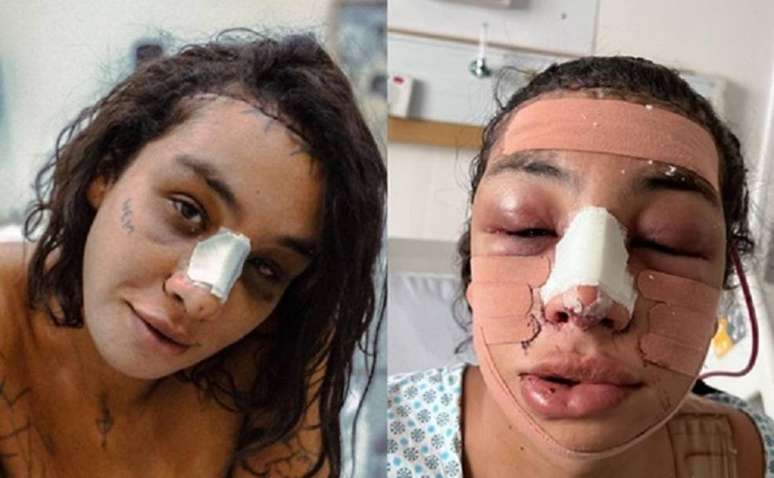 Linn da Quebrada se recupera após cirurgia de feminização facial.