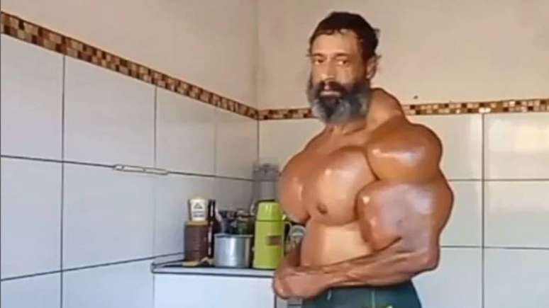 Uso de Synthol e ADE pode ser fatal