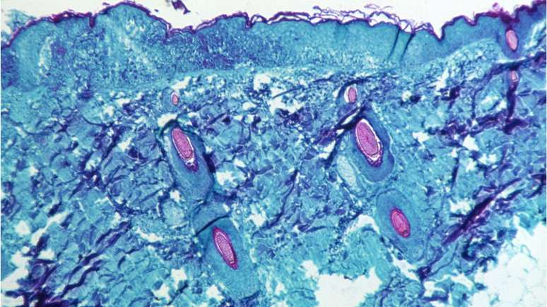 Amostra de pele infectada com o vírus monkeypox