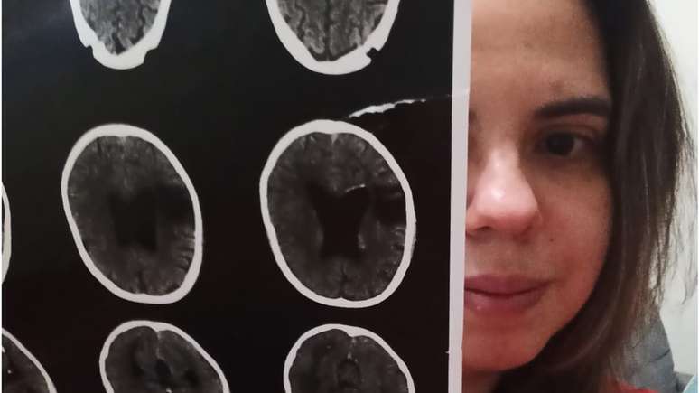 Camila Fabro demorou dois anos para ser diagnosticada corretamente com agnosia e prosopagnosia adquirida