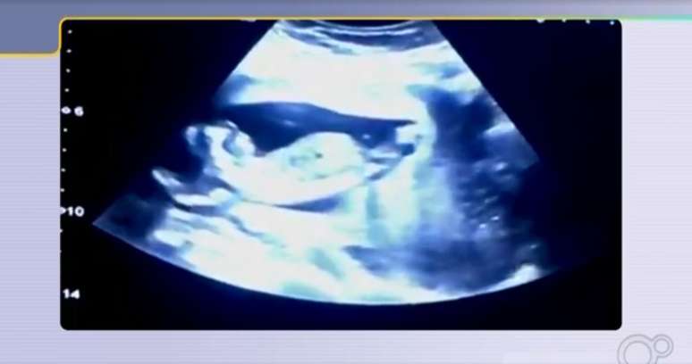 Ultrassom com o sexo do bebê é mostrada ao vivo em telejornal da Globo