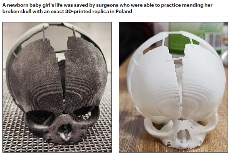 A vida da recém-nascida foi salva por cirurgiões que puderam praticar a restauração de seu crânio em uma réplica 3D exata impressa na Polônia