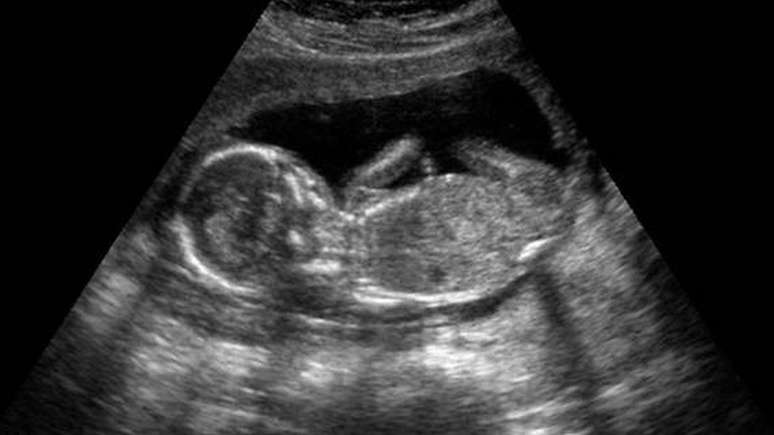 Um cadáver com batimentos cardíacos pode ainda ser capaz de sustentar um feto em crescimento.