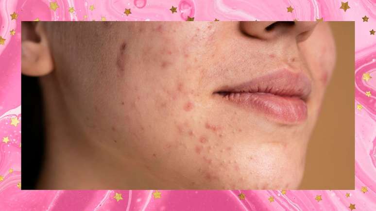 Veja as diferenças entre acne e rosácea