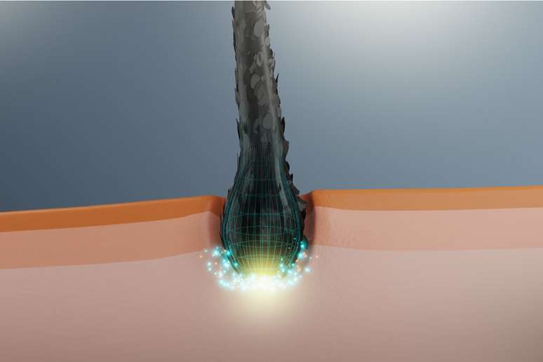 Transplante capilar é considerado uma solução difinitiva para calvície 