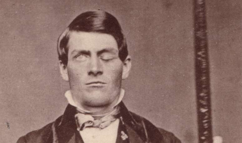 Phineas P. Gage (1823–1860), que teve cabeça atravessada por barra de ferro em 13 de setembro de 1848